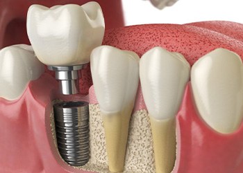 a 3D illustration of a dental implant in the jawbone