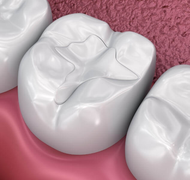 Illustrated teeth with dental sealants