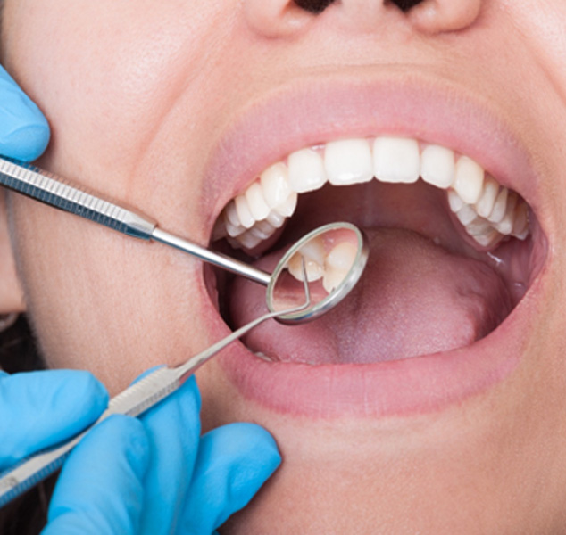 A closeup of a woman’s mouth during a dental checkup