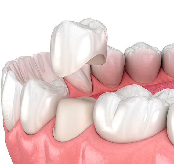 Illustration of dental crown being placed on tooth