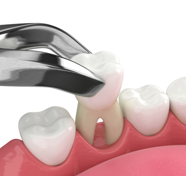 Illustration of tooth being extracted