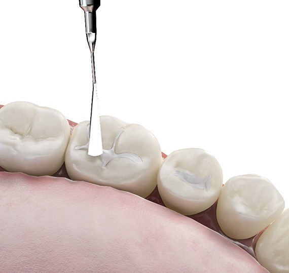 Rendering of composite resin applied to teeth in lower arch with white background