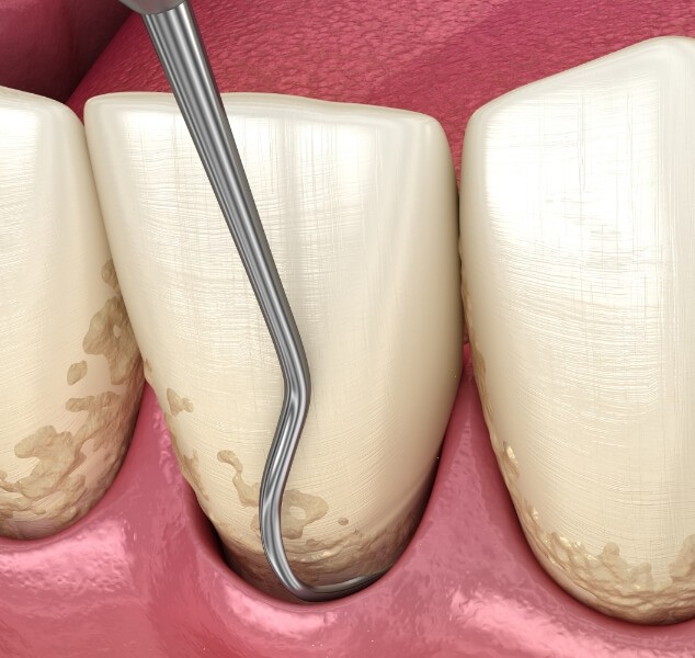 Illustrated dental scaler clearing plaque buildup from teeth during gum disease treatment