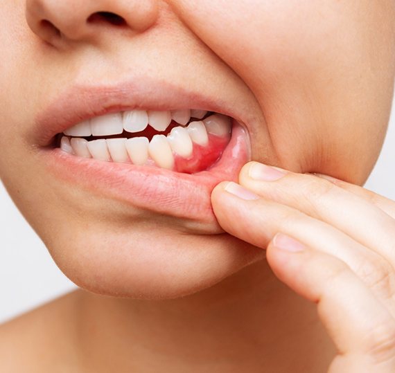 Closeup of patient with red, inflamed gums