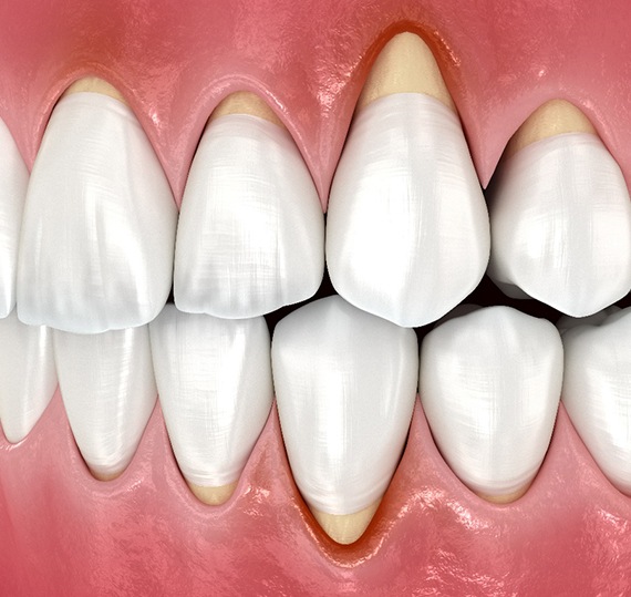 Illustration of gum recession