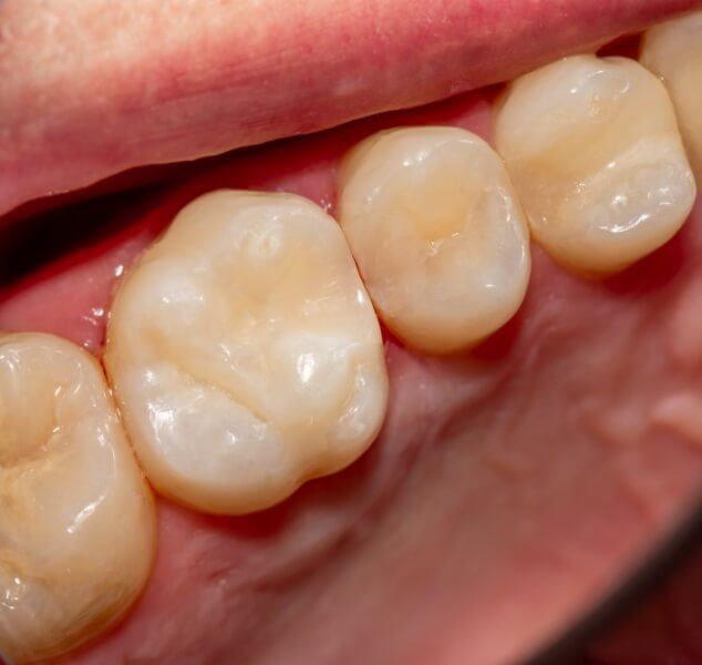 Close up of row of teeth after restorative dentistry in Springfield