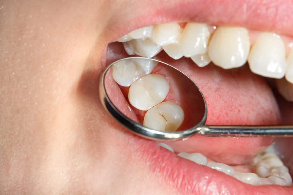 Dentist checking patient with tooth-colored fillings